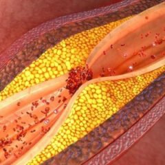 Le syndrome dyslipidémique