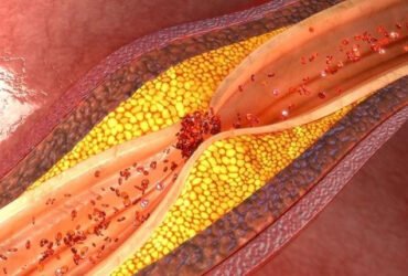 dyslipidemies-1 (1)